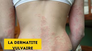 Dermatite vulvaire eczéma et lichen simplex chronique [upl. by Ennaeiluj287]