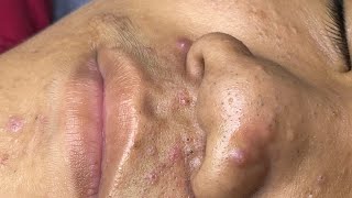 ACNE TREATMENT VU QUYNH MI Acne On Boys Nose 2024 [upl. by Lynden]