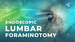 What is Endoscopic Lumbar Foraminotomy [upl. by Yaf]