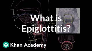 What is epiglottitis  Respiratory system diseases  NCLEXRN  Khan Academy [upl. by Ylrak]