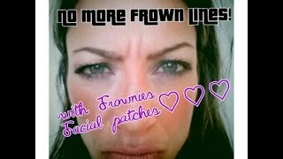 Get rid of wrinkles amp quotthe 11squot  frown lines with FROWNIES  NO BOTOX facetape [upl. by Aniwde]