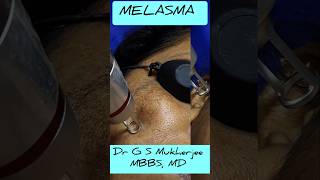 Laser treatment for Melasma  Hyperpigmentation  Lentigens  Nd Yag pico laser  drgsmukherjee [upl. by Terag]