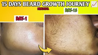 15 days beard growth journey  With Minoxidil ✅📈 BEARDGROWTHJOURNEY [upl. by Maitund]