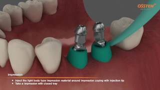 OSSTEM TSIII Fixture Placement Impression taking Pick up and Transfer Impression Copings [upl. by Matejka]