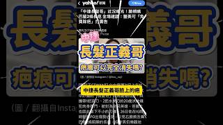 中捷「長髮正義哥」臉上的疤，可以完全消除嗎？shorts 中捷 [upl. by Gibrian]