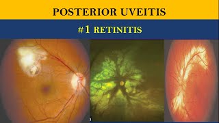 POSTERIOR UVEITIS  retinitis vs choroiditis [upl. by Thorner]