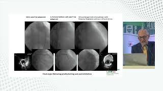 Calcium Debulking Strategy using Rotational Atherectomy by Dr Imad Sheiban [upl. by Rieth]