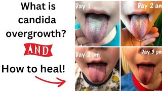 7 Symptoms You Didnt Know where Candida Overgrowth And What to do about it [upl. by Maclay]