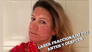 Laser fraccionado CO2 acne manchas y rejuvenecimiento  1 experiencia [upl. by Elawalo]