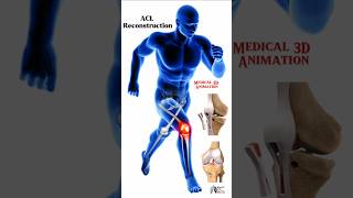 ACL Reconstruction  Patellar Harvest  3D Animation knee kneepain kneerehab [upl. by Eecal905]