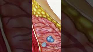 Understanding 🎗️Incisional Breast Biopsy 🌸 PreOp Shorts PreOp® Patient Education pt 3 [upl. by Attolrahc]