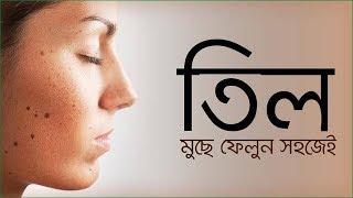 Til dur korer upay  চিরতরে মুখের ছোট ছোট কালো তিল দূর করবেন যে ভাবে। [upl. by Simson]