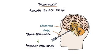 Understanding Acromegaly [upl. by Ahsasal]