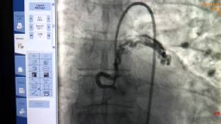 Coronary Angiography Coronary Arterio Venous Fistula to Pulmonary Artery [upl. by Ahsien]