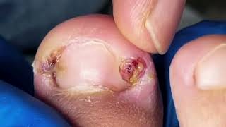 Pus Leaks Out of Severely Infected Ingrown Toenails 【Yinuo Pedicure】 [upl. by Imot]