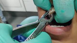 Painless and Easiest method for tooth extraction [upl. by Pronty]