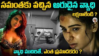 సమంతకి వచ్చిన వ్యాధి వలన కలిగే నష్టాలేంటి   Symptoms amp treatment for Samantha Myositis [upl. by Hintze]