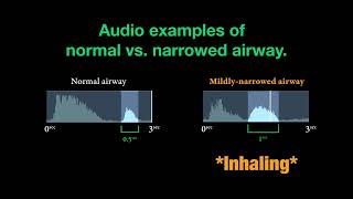 Trouble Breathing How to Hear a Narrow Airway due to Tracheal Stenosis [upl. by Lledyl]