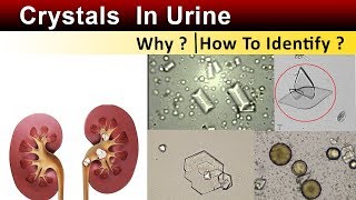 Crystals In Urine  Why amp How to Identify [upl. by Onateag464]