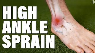 High Ankle Sprain  Syndesmosis Injury Evaluation  Education  Exercises [upl. by Penni]