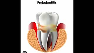 What is periodontitisWhat is periodontitis diseasePeriodontitissorts smile [upl. by Agna]