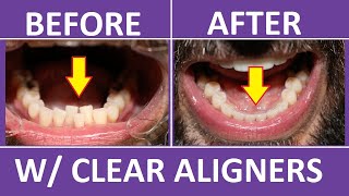 Invisalign Braces Before and After Overbite Crowding Teeth Cost Pain Tips 3M Clear Aligners [upl. by Olvan]