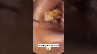 Remoção de Cravos e Espinhas  Vídeo Satisfatório 36 [upl. by Redvers803]