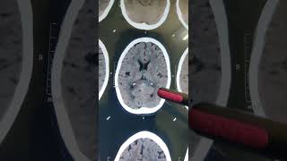 INTRACRANIAL CALCIFICATION doctor hospital  shorts video [upl. by Nosauq934]