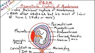 premature rupture of membranes [upl. by Sateia]