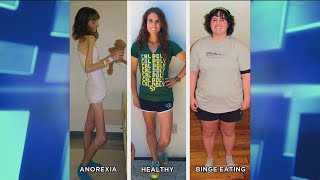 How an Anorexic Can Become a Binge Eater [upl. by Farkas241]