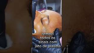 Remoção de dermatose populosa nigra🤭Quando cicatriza venho mostrar o resultado [upl. by Merow]