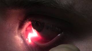 Ophthalmic Skills Video  Basics in Slit Lamp Examination [upl. by Yniattirb145]