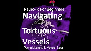 How to Navigate Tortuous Vessels in NeuroEndovascular Procedures [upl. by Armat956]