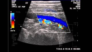 Introduction to the Lower Extremity Venous Doppler Study [upl. by Ettevram]