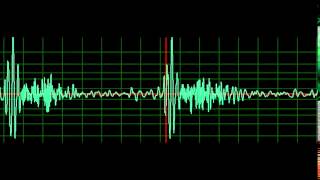 Mitral Regurgitation normal speed [upl. by Gawlas]