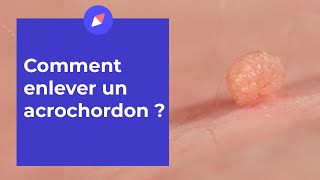 Acrochordons  comment sen débarrasser [upl. by Ensoll]