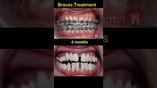 30 months Braces Transformation dentalcare satisfying dentist dentalclinic dentalhealth shorts [upl. by Hurlee]