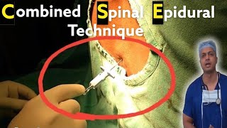 Combined Spinal Epidural Anaesthesia technique  Procedural Video from Start to End  anesthesia [upl. by Hyacinthie]