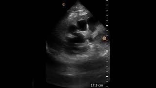 Severe Hydronephrosis  Ultrasound Image Interpretation [upl. by Eberhart546]