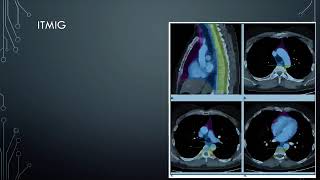 Clasificación de Mediastino de la ITMIG [upl. by Elene25]