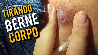 🎯 COMO RETIRAR BERNE NO CORPO HUMANO ❌️ [upl. by Hpeosj]