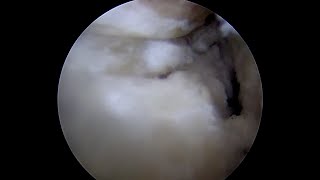 Labral Partial Detachment with Surrounding Grade 2 Articular Cartilage Injury [upl. by Adnilra]