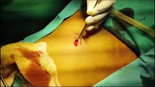 Hasson open technique for Laparoscopic surgery by Dr Sekendar Ali MS FMAS Lap Surgeon 📝 [upl. by Nomled377]