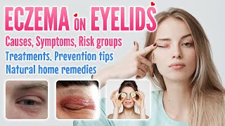 Eczema on Eyelids Causes Symptoms Risk factors Treatment Prevention and Home Remedies Options [upl. by Aitnahs]