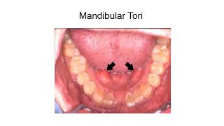 Preprosthetic surgery Hard tissue procedures [upl. by Malvino]