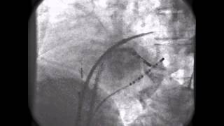 HandsOn Ablation  Video 1225 [upl. by Lorry]