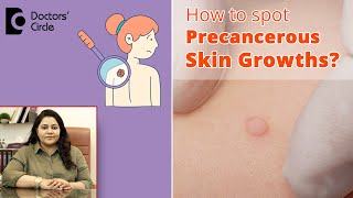 Skin Lesions and Cancer How to spot Precancerous Skin Growths DrTina RamachanderDoctors Circle [upl. by Renrag]