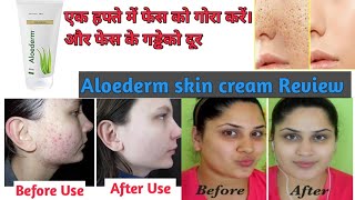 Aloederm skin cream Review and benefits in hindi  hindi health tips 4u [upl. by Milstone532]