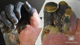 Gangrene and its types dry gangrene wet gangrene gas gangrene mci fmge neetpg [upl. by Chee]