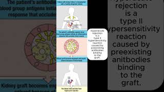 Hyperacute rejection is a type 2 hypersensitivity reaction caused by preexisting antibodies [upl. by Bailey]